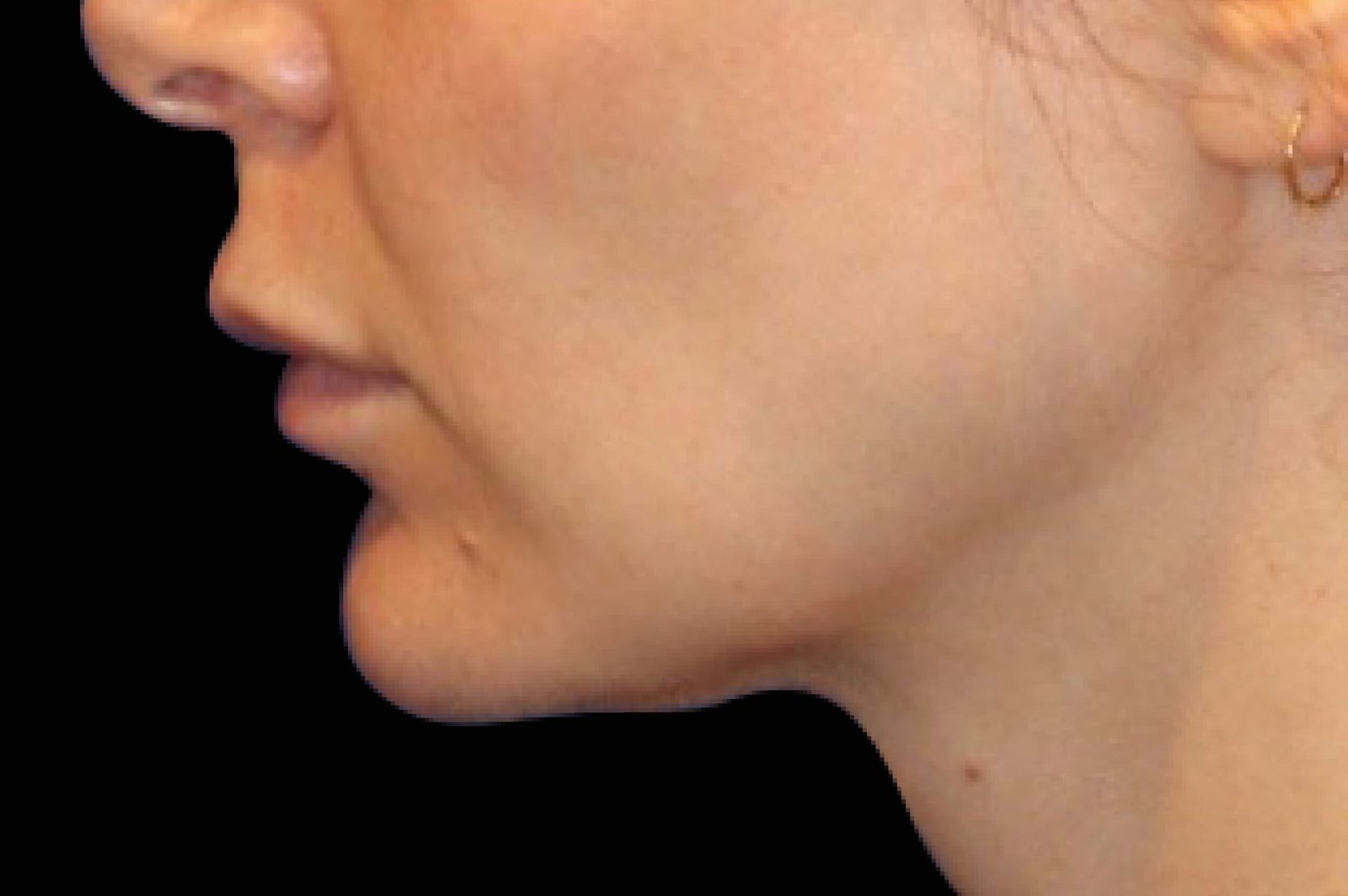 emface-before-after-12-scaled-1.jpg